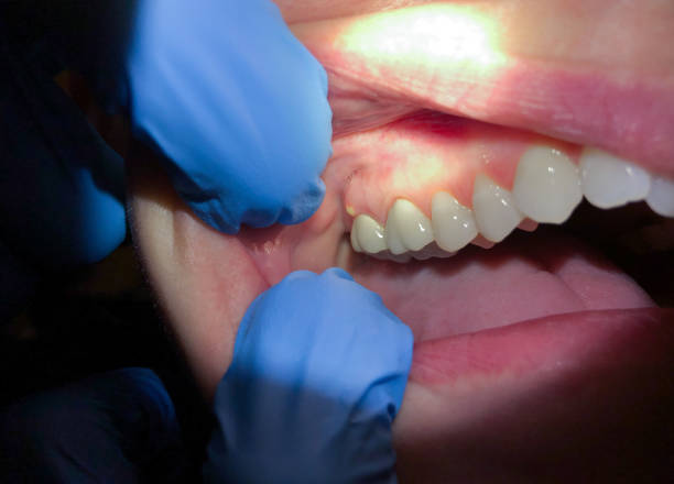 Best Emergency Dental Care for Broken or Chipped Teeth in Minneola, FL