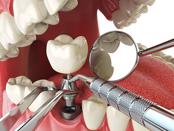 Best Emergency Denture Repair in Minneola, FL